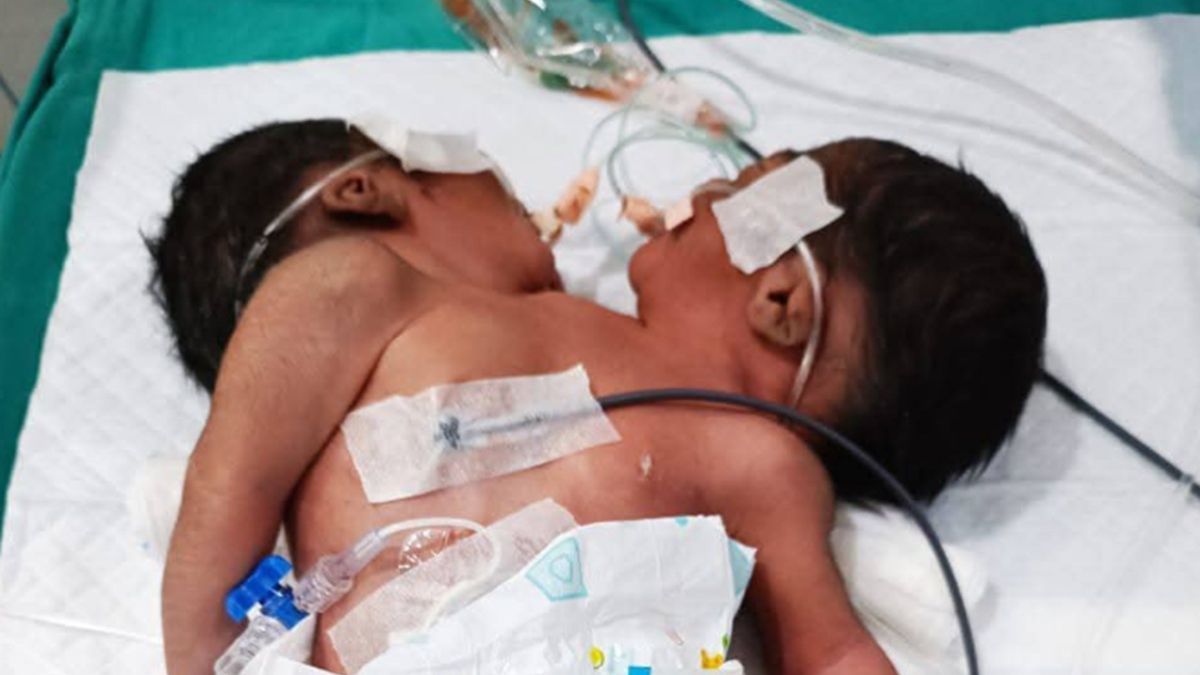 Baby Born with Two Heads in India: Rare Condition Under Doctors' Care