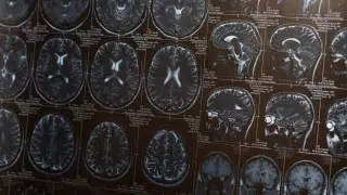 Jańa zertteý: Mıdy saqtaýdyń qarapaıym ádisi demensıa qaýpin 40%-ǵa azaıtady